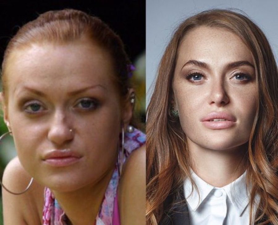 Слава Камінська пластика до і після